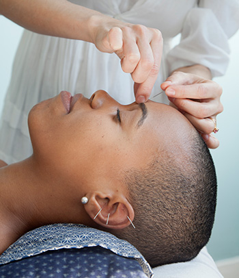 Woman receiving acupuncture treatments