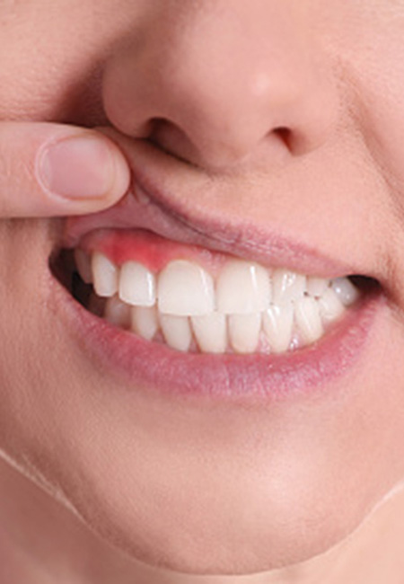 Woman showing inflamed gums.