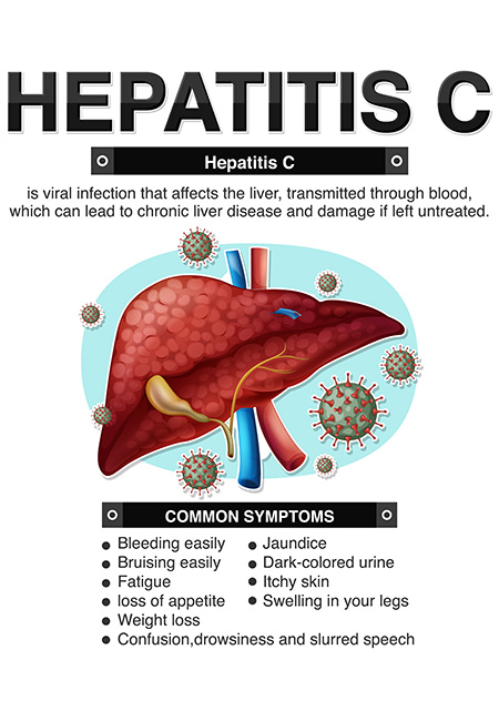 Symptoms of Hepatitis C.